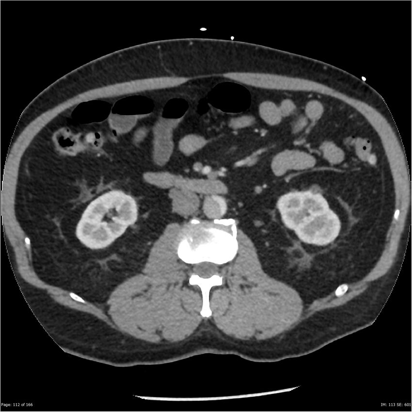 Aortic dissection- Stanford A (Radiopaedia 37759-39664 A 103).jpg