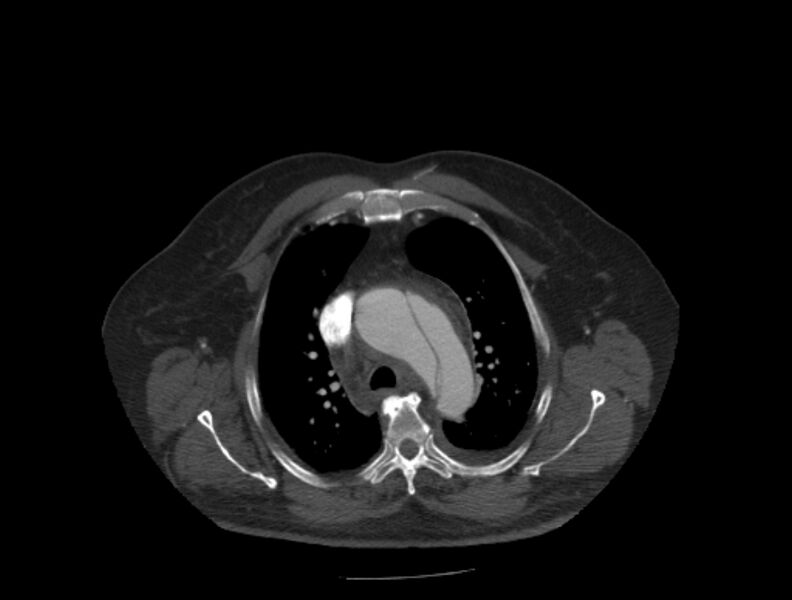 File:Aortic dissection (Radiopaedia 28802-29105 A 8).jpg