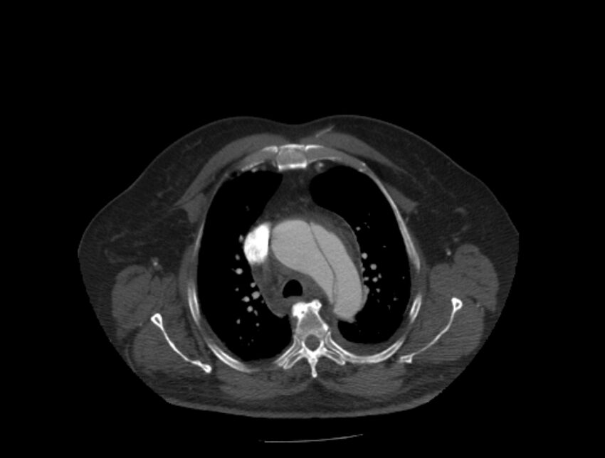 Aortic dissection (Radiopaedia 28802-29105 A 8).jpg