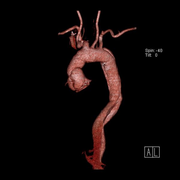 File:Aortic dissection - De Bakey type III - Stanford B (Radiopaedia 21903-21882 3D C+ arterial phase 17).jpg