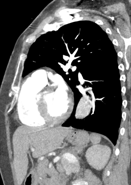 File:Aortic dissection - Stanford type B (Radiopaedia 50171-55512 C 17).png