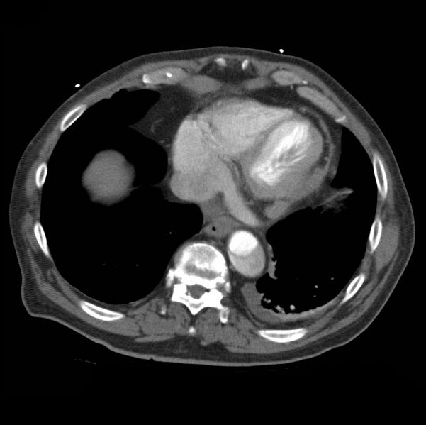 File:Aortic dissection with rupture into pericardium (Radiopaedia 12384-12647 A 43).jpg