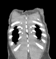 Aortic valve non-coronary cusp thrombus (Radiopaedia 55661-62189 C 74).png