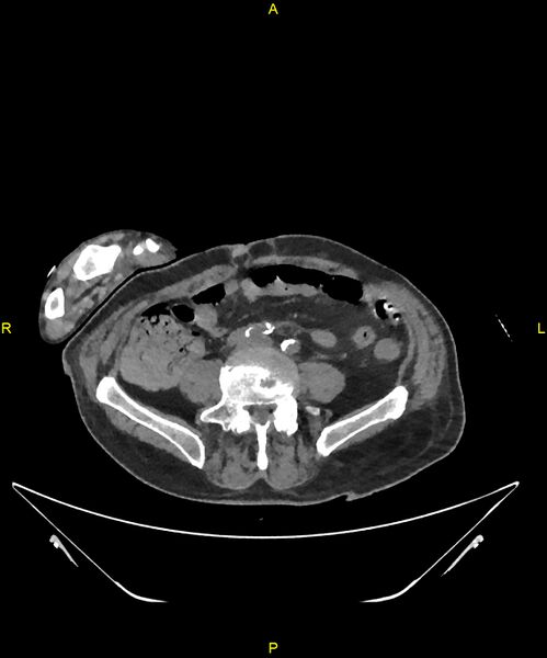 File:Aortoenteric fistula (Radiopaedia 84308-99603 Axial non-contrast 242).jpg