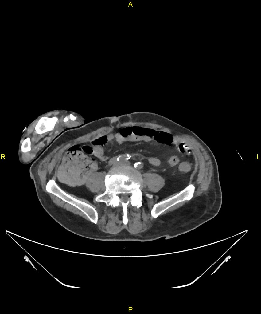 Aortoenteric fistula (Radiopaedia 84308-99603 Axial non-contrast 242).jpg