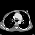 Aortopulmonary window, interrupted aortic arch and large PDA giving the descending aorta (Radiopaedia 35573-37074 B 31).jpg