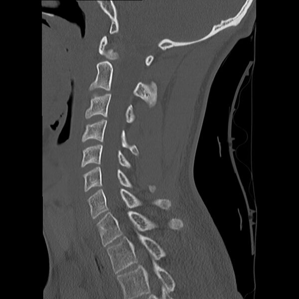 File:Apical pneumothorax on cervical spine CT (Radiopaedia 45343-49368 Sagittal bone window 20).jpg