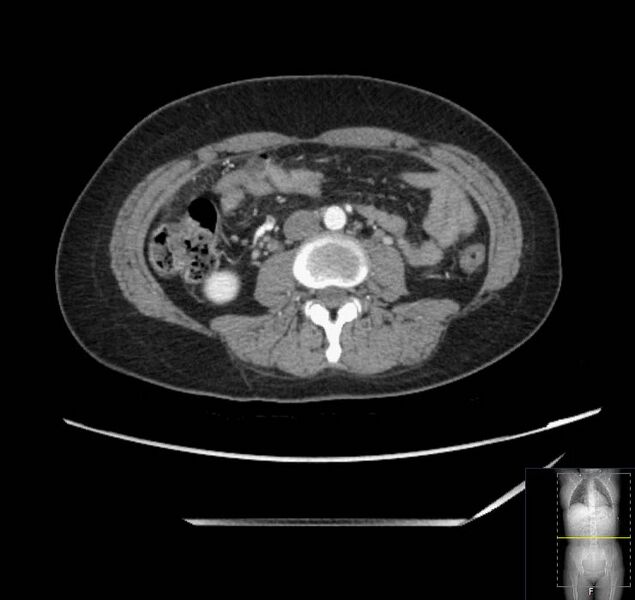 File:Appendicitis (CT angiogram) (Radiopaedia 154713-127660 Axial 73).jpg