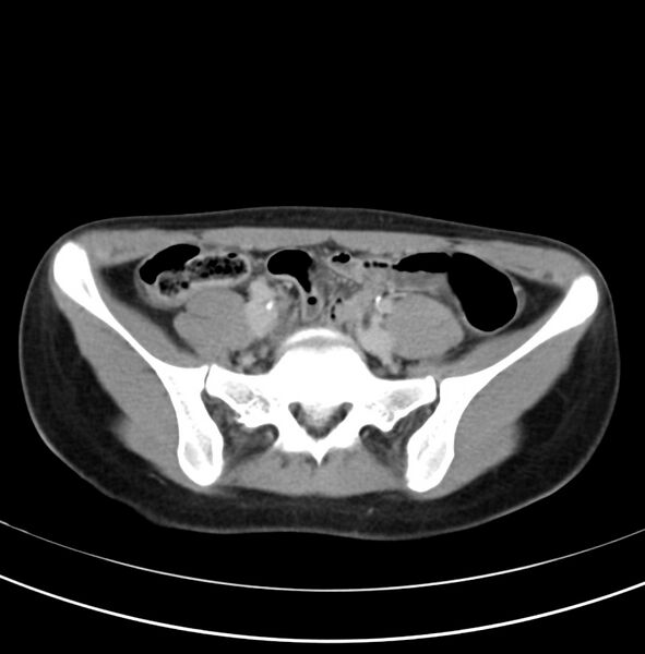 File:Appendicitis and incidental bicornuate uterus (Radiopaedia 22833-22853 Axial C+ delayed 27).jpg