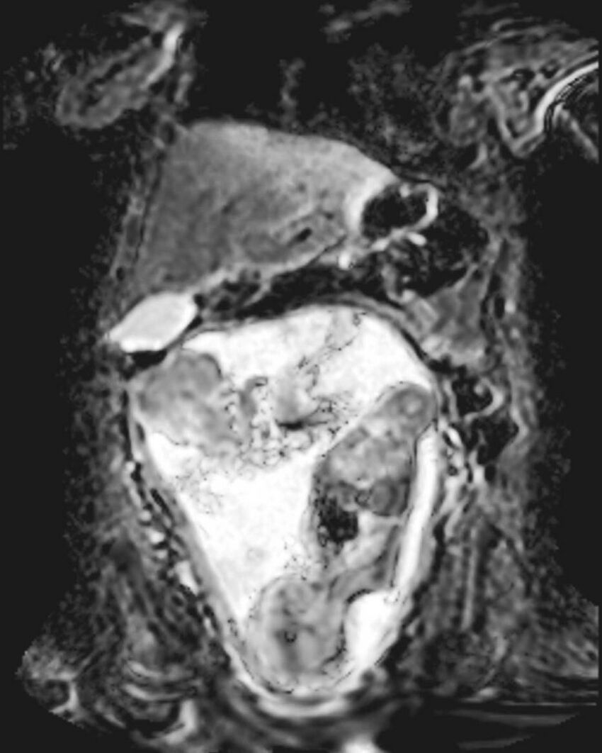 Appendicitis in gravida (MRI) (Radiopaedia 89433-106395 Coronal ADC 20).jpg