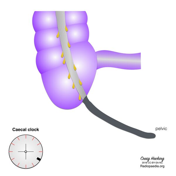 File:Appendix position (diagram) (Radiopaedia 62911-71293 C 5).jpeg