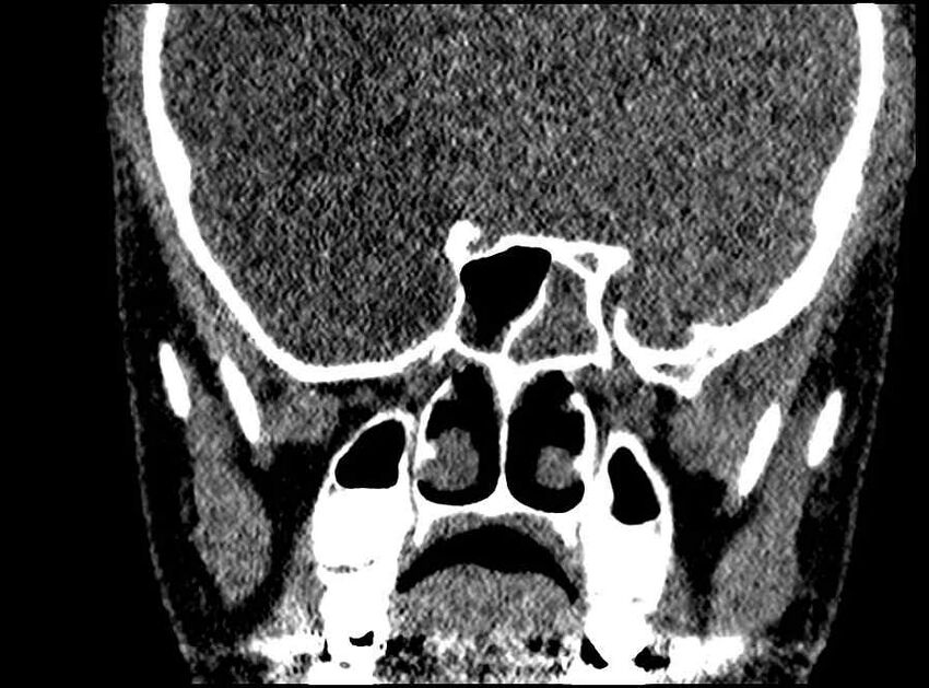 Arachnoid cyst- extremely large (Radiopaedia 68741-78450 Coronal bone window 28).jpg