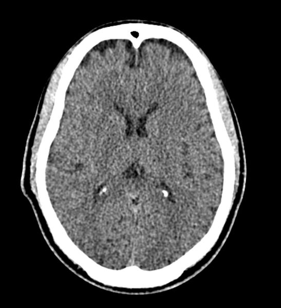 File:Arachnoid cyst of the ambient cistern (Radiopaedia 81301-94986 Axial non-contrast 40).jpg