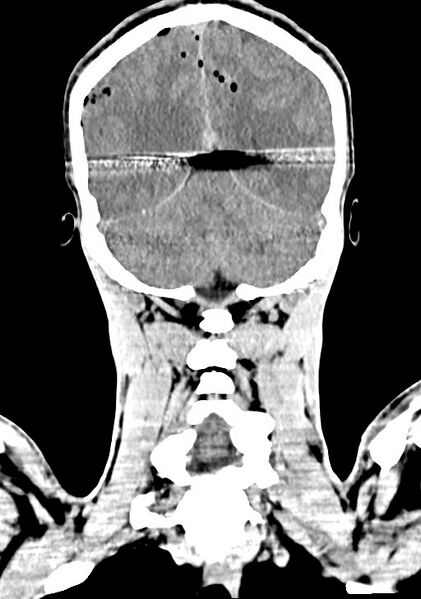 File:Arrow injury to the brain (Radiopaedia 72101-82607 Coronal non-contrast 54).jpg