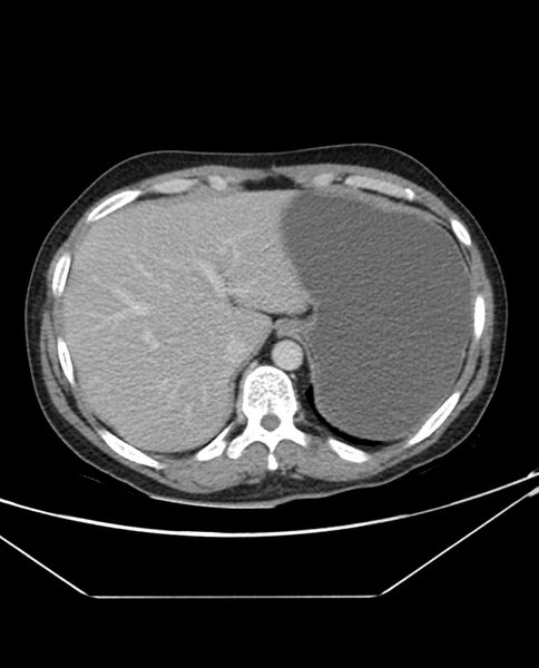 File:Arterial occlusive mesenteric ischemia (Radiopaedia 84641-100054 A 20).jpg