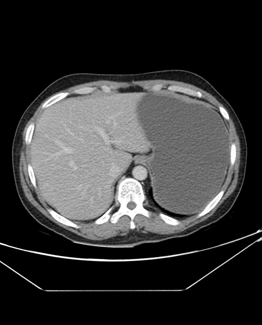 Arterial occlusive mesenteric ischemia (Radiopaedia 84641-100054 A 20).jpg
