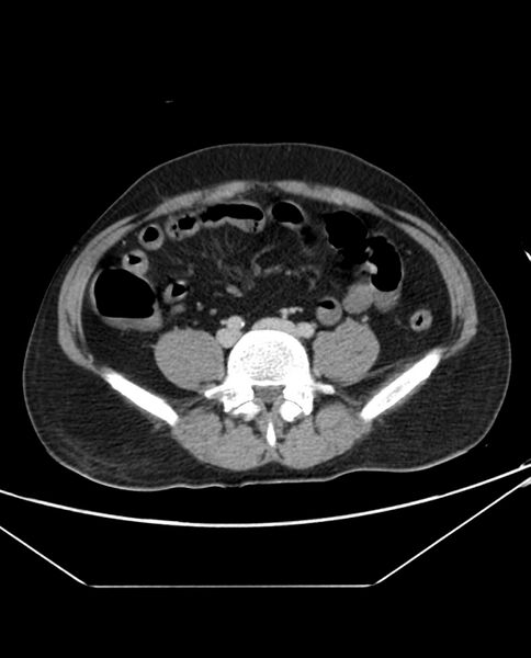 File:Arterial occlusive mesenteric ischemia (Radiopaedia 84641-100054 A 80).jpg