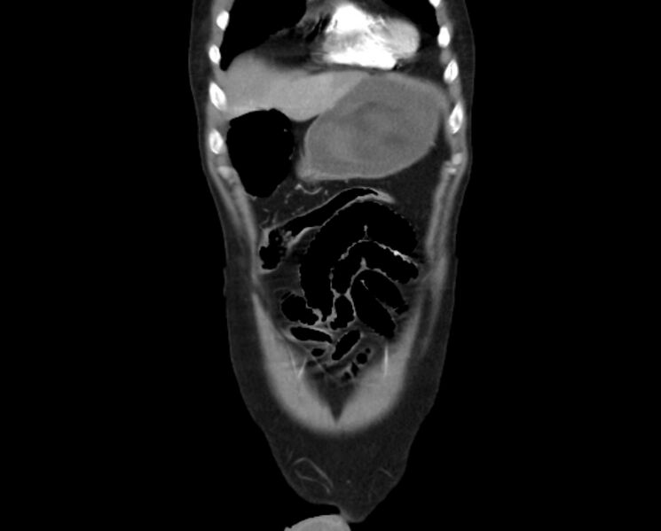 File:Arterial occlusive mesenteric ischemia (Radiopaedia 84641-100060 B 8).jpg