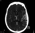 Arteriovenous malformation - cerebral (Radiopaedia 8172-14682 A 11).jpg