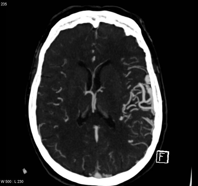 File:Arteriovenous malformation - cerebral (Radiopaedia 8172-14682 A 11).jpg
