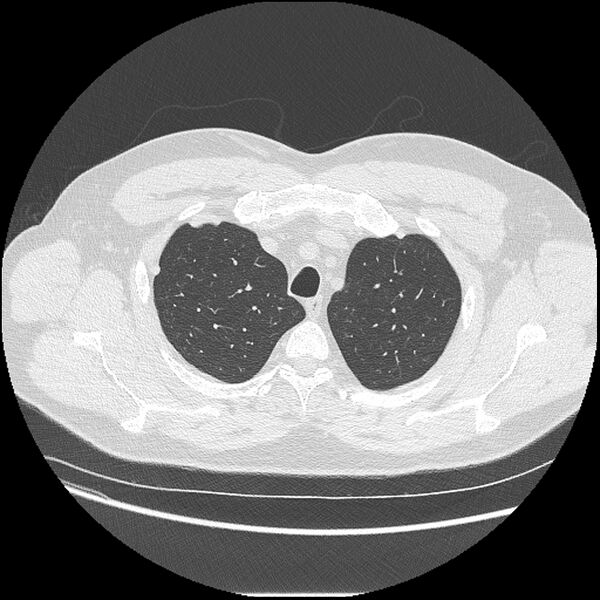 File:Asbestosis (Radiopaedia 45002-48961 Axial lung window 9).jpg