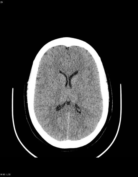 File:Astroblastoma (Radiopaedia 39792-42216 Axial non-contrast 28).jpg