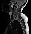 Astrocytoma - spinal cord (Radiopaedia 69769-79758 Sagittal T2 1).jpg