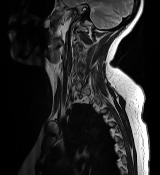 File:Astrocytoma - spinal cord (Radiopaedia 69769-79758 Sagittal T2 1).jpg