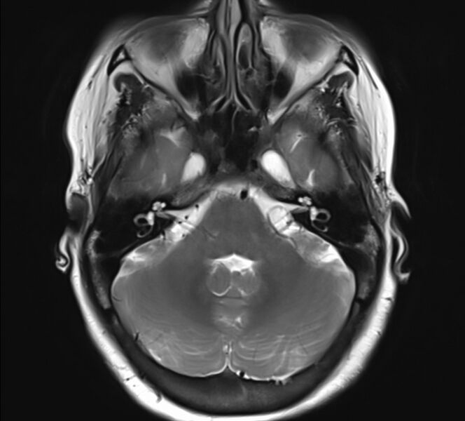 File:Atlanto-occipital assimilation with basilar invagination (Radiopaedia 70122-80157 Axial T2 6).jpg