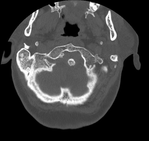 File:Atlanto-occipital assimilation with basilar invagination (Radiopaedia 70122-80188 Axial bone window 12).jpg