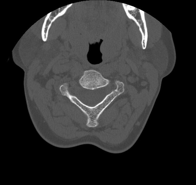 File:Atlanto-occipital assimilation with basilar invagination (Radiopaedia 70122-80188 Axial bone window 46).jpg