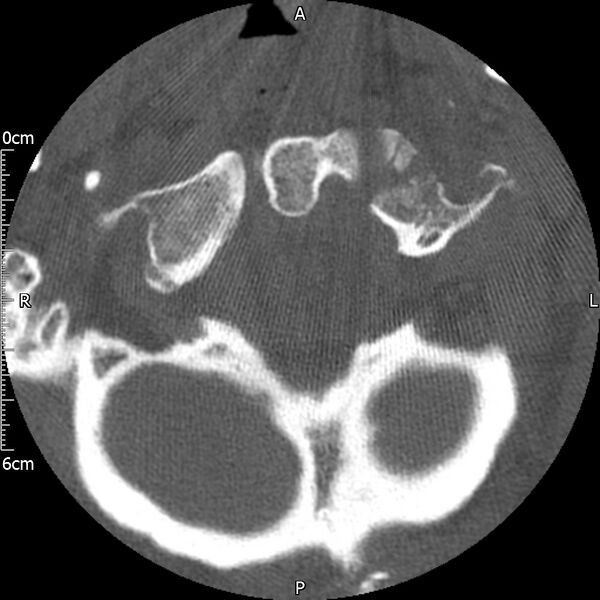 File:Atlas fracture with Currarino type A congenital defect (Radiopaedia 71747-82144 Axial bone window 36).jpg