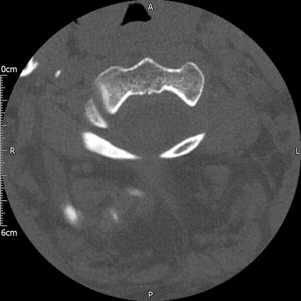 File:Atlas fracture with Currarino type A congenital defect (Radiopaedia 71747-82144 Axial bone window 49).jpg