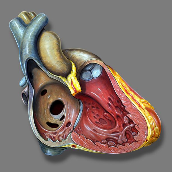 File:Atrial septal defect - right heart view (illustration) (Radiopaedia 36357).jpg