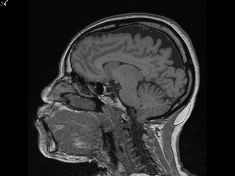 File:Atypical meningioma - intraosseous (Radiopaedia 64915-74572 Sagittal T1 74).jpg