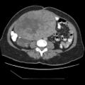 Atypical retroperitoneal lymphocoeles with large leiomyoma of uterus (Radiopaedia 32084-33024 A 23).jpg