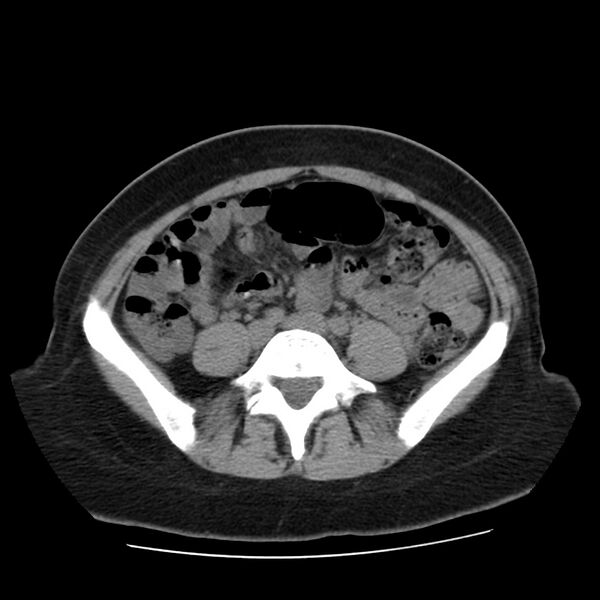 File:Autosomal dominant polycystic kidney disease (Radiopaedia 23061-23093 Axial non-contrast 45).jpg