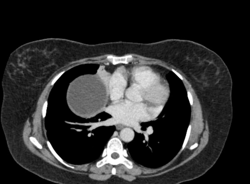 File:Autosomal dominant polycystic kidney disease (Radiopaedia 57124-64017 A 5).jpg