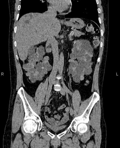 File:Autosomal dominant polycystic kidney disease (Radiopaedia 87830-104287 Coronal non-contrast 30).jpg