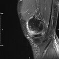 Avulsion fracture of the fibular head (Radiopaedia 74804-85808 Sagittal PD fat sat 6).jpg