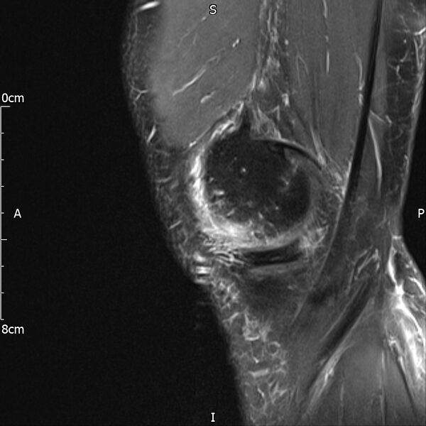 File:Avulsion fracture of the fibular head (Radiopaedia 74804-85808 Sagittal PD fat sat 6).jpg