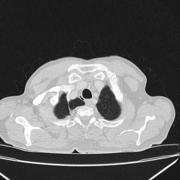 File:Azygos lobe (Radiopaedia 38259-40275 Axial lung window 7).jpg