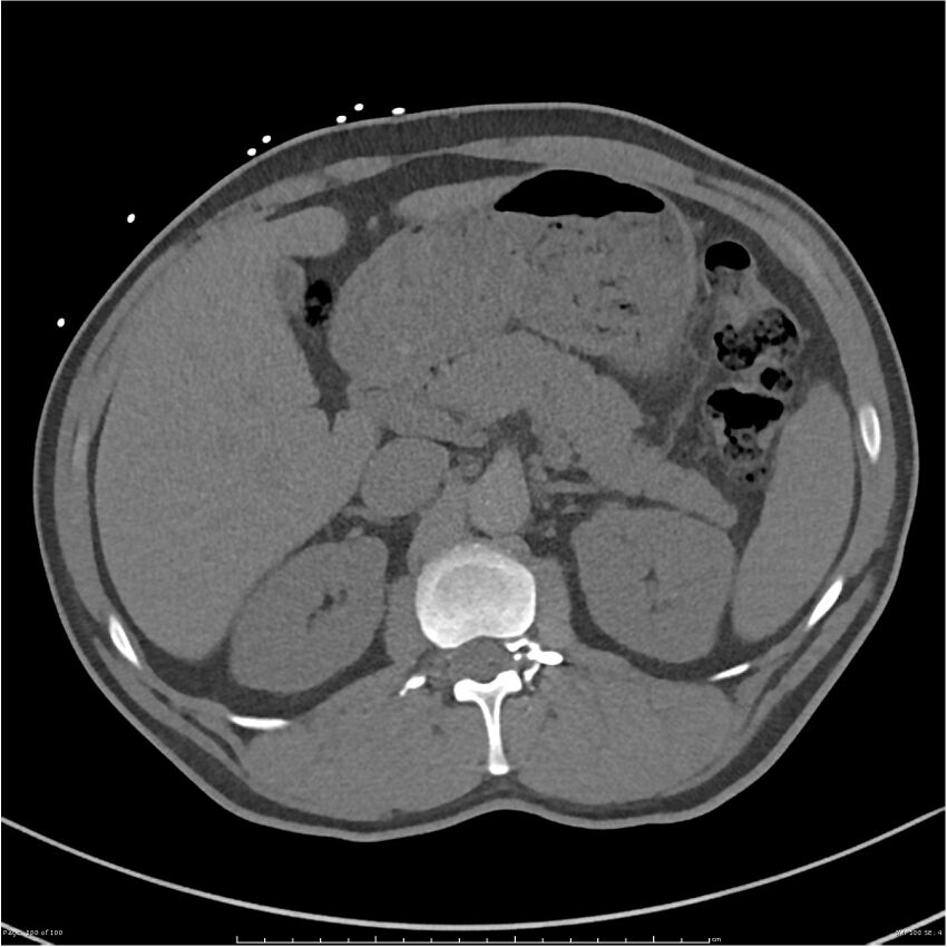 Azygos venous system anatomy (CT pulmonary angiography) (Radiopaedia 25928-26077 Axial C+ CTPA 100).jpg