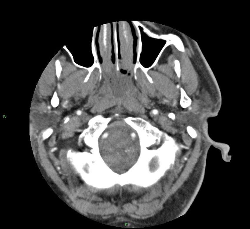 Basal ganglia hemorrhage (Radiopaedia 58763-65985 D 17).jpg