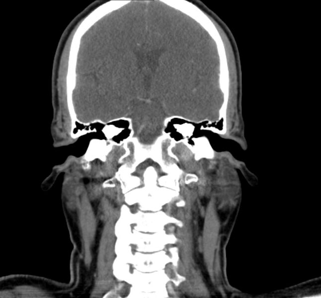 File:Benign mixed salivary tumor of the parotid gland (Radiopaedia 35261-36792 B 20).jpg