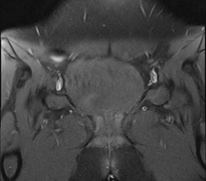 File:Bicornuate uterus (Radiopaedia 71214-81511 Coronal T1 fat sat 27).jpg