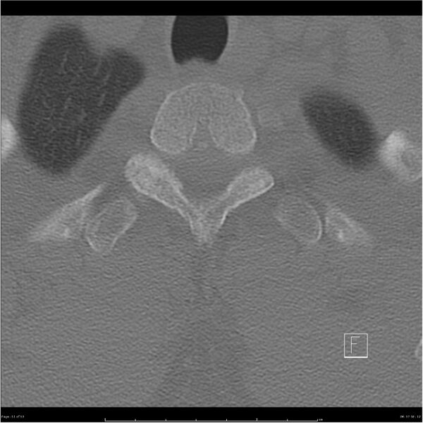 File:Bilateral cervical ribs (Radiopaedia 25868-26017 Axial bone window 51).jpg