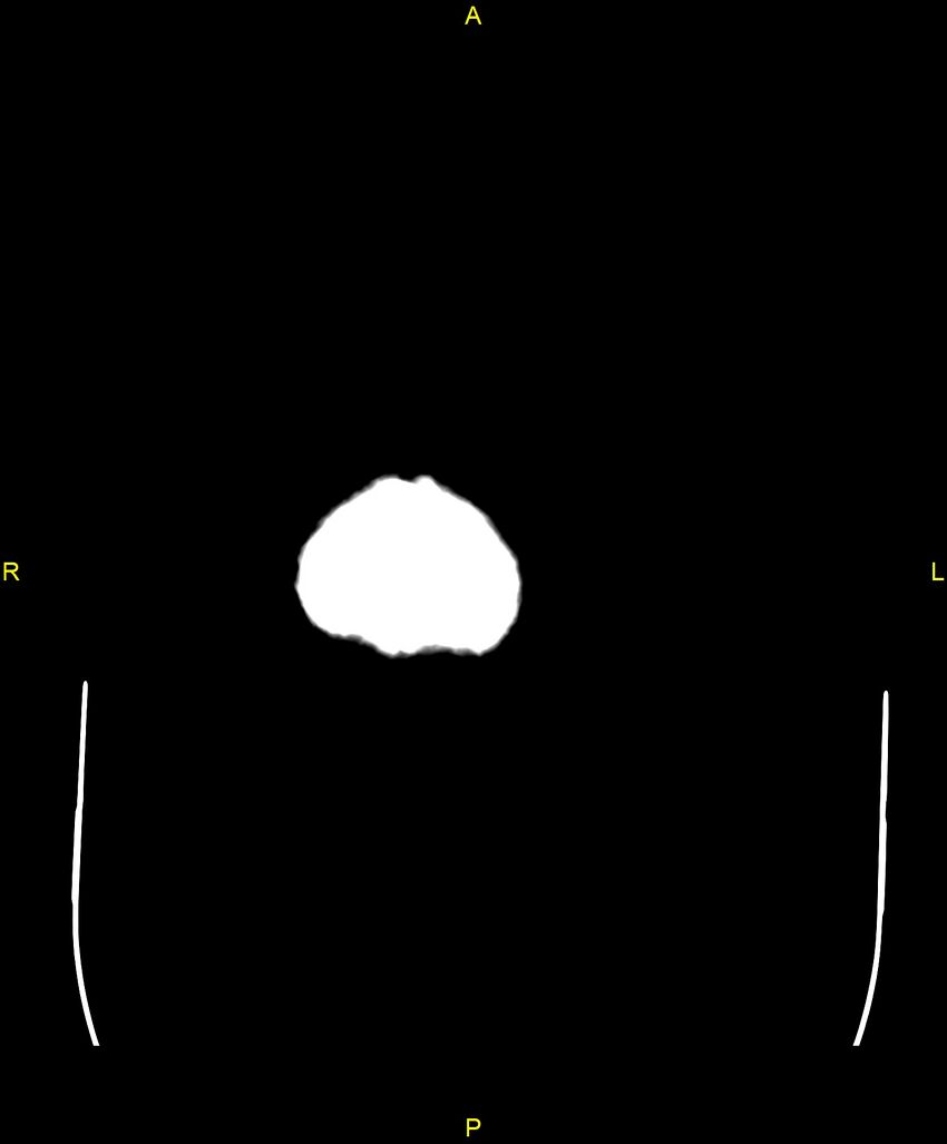 Bilateral isodense subdural hematomas (Radiopaedia 88621-105325 Axial non-contrast 113).jpg