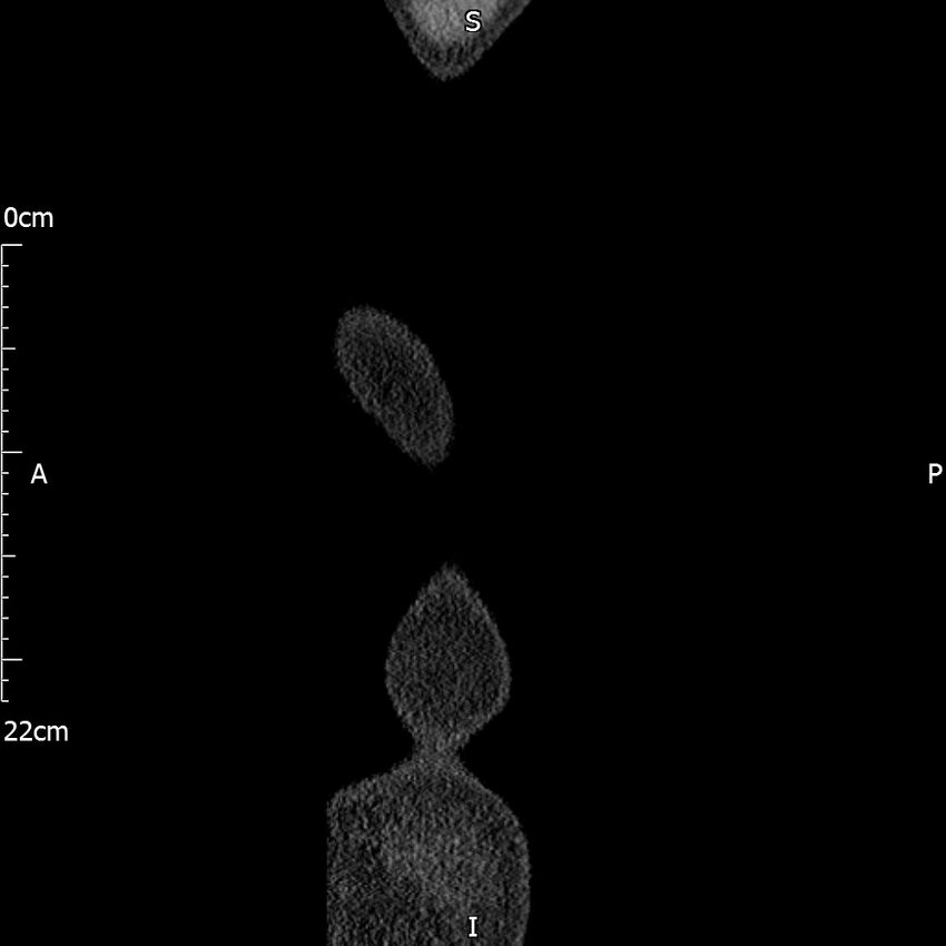 Bilateral medullary nephrocalcinosis with ureteric calculi (Radiopaedia 71269-81569 C 114).jpg