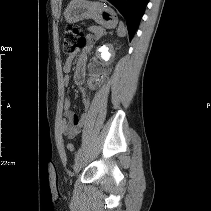 Bilateral medullary nephrocalcinosis with ureteric calculi (Radiopaedia 71269-81569 C 42).jpg